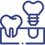 Implantes Dentários
