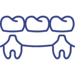 Prótese fixa sobre dentes